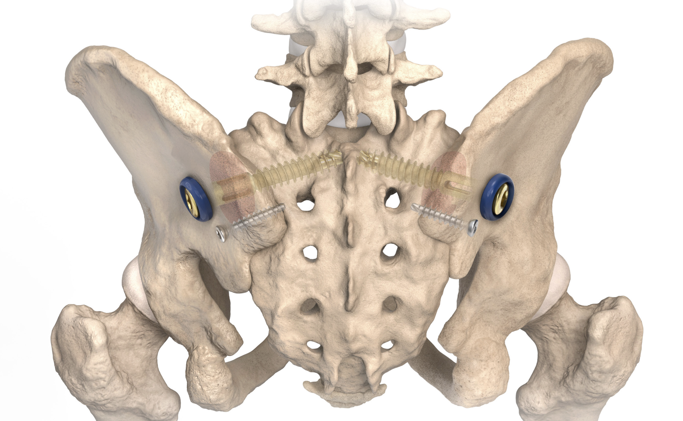 Integrity SI Fusion System